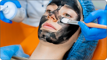 Carbon Laser Peel
