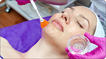 Chemical Peels
