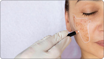 Pigmentation Removal